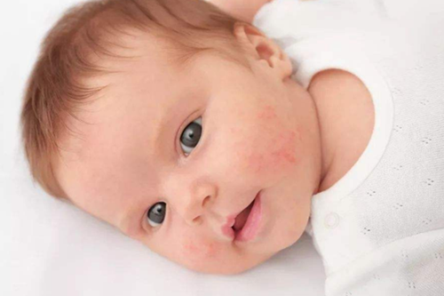 宝宝长湿疹用地塞米松软膏成为敏感肌，应该如何护理?