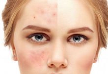 因为过度护肤变成敏感肌了之后怎么办?-源自护肤官网-专业指导敏感肌肤