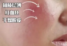 红血丝和敏感肌肤是什么关系?调理红血丝在日常饮食上有什么注意?-源自护肤官网-专业指导敏感肌肤
